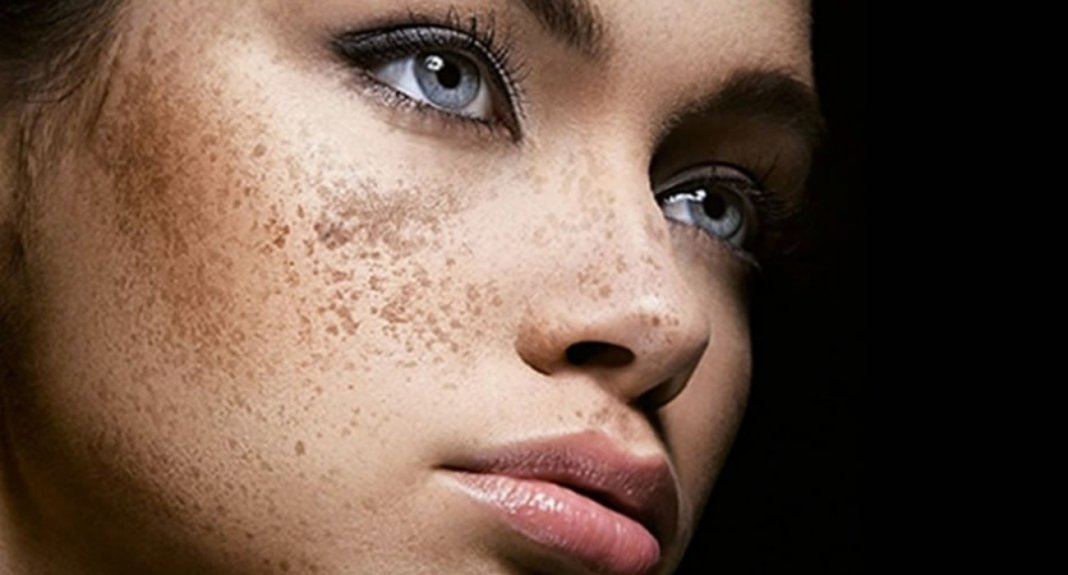 Melasma, saiba sua causa e como prevenir