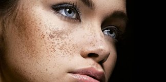 Melasma, saiba sua causa e como prevenir