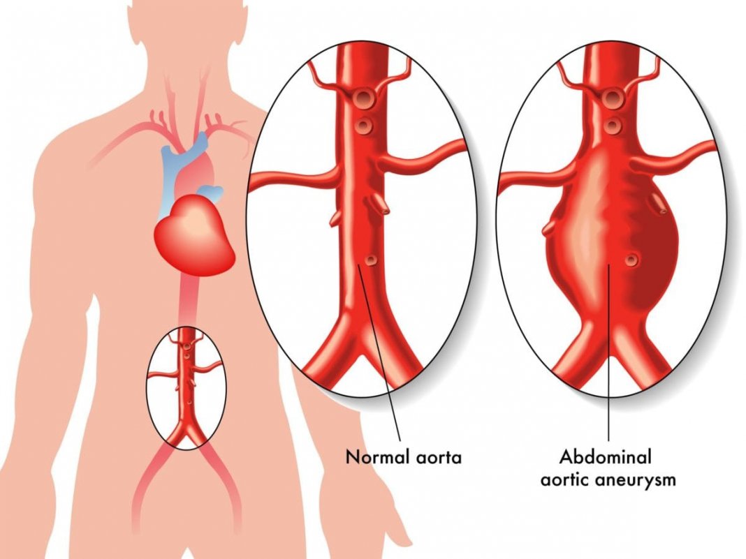 Aneurisma da Aorta: Prevenção e Tratamento