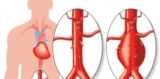 Aneurisma da Aorta: Prevenção e Tratamento