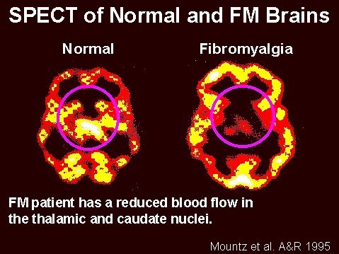 sabervivermais.com - Fibromialgia não é coisa da sua imaginação