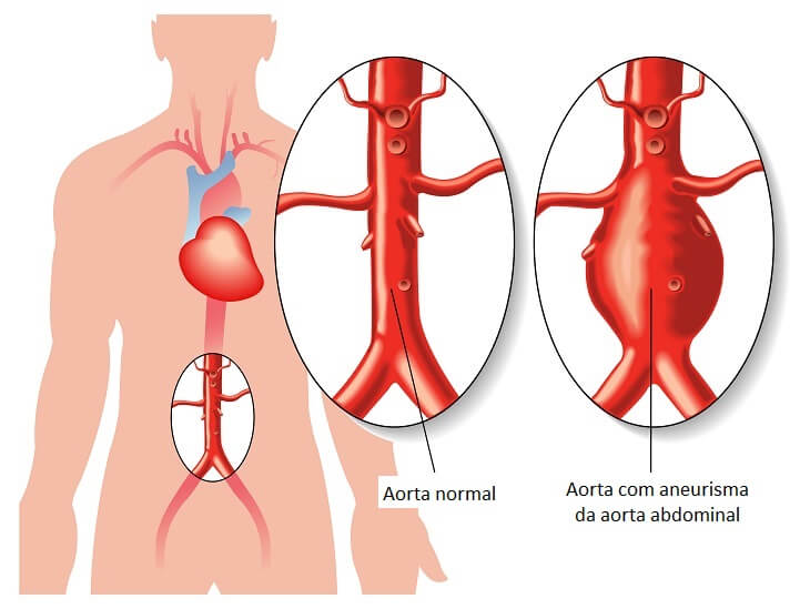 sabervivermais.com - Aneurisma da Aorta: Prevenção e Tratamento