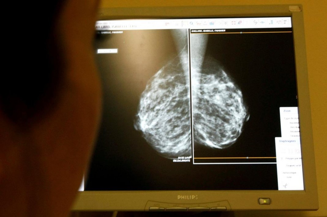 Cientistas identificam composto capaz de bloquear metástases de cânceres