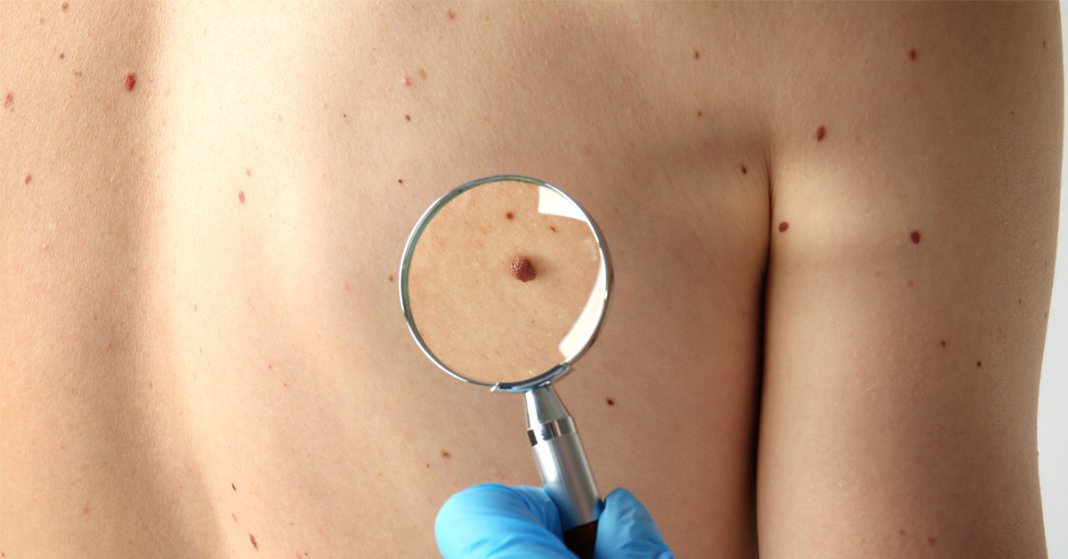 07 mitos desbancados sobre o câncer de pele