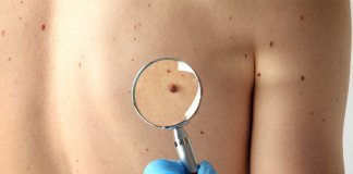 07 mitos desbancados sobre o câncer de pele