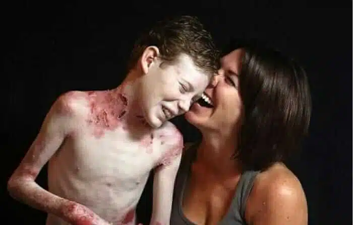 sabervivermais.com - Faleceu aos 17 anos o &ldquo;Garoto borboleta&rdquo;, ele nos deixa v&aacute;rias li&ccedil;&otilde;es sobre a vida