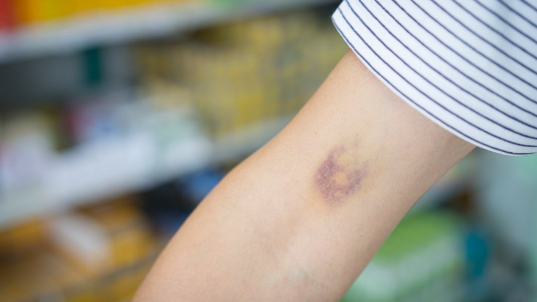 Hematomas surgem com frequência em você? Isso pode ser sintoma de uma dessas doenças