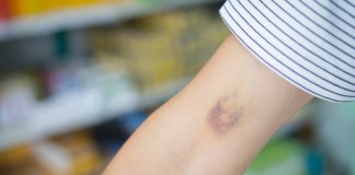 Hematomas surgem com frequência em você? Isso pode ser sintoma de uma dessas doenças