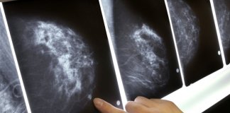 Adeus mamografia: Um novo exame de sangue que detectaria precocemente o câncer de mama.