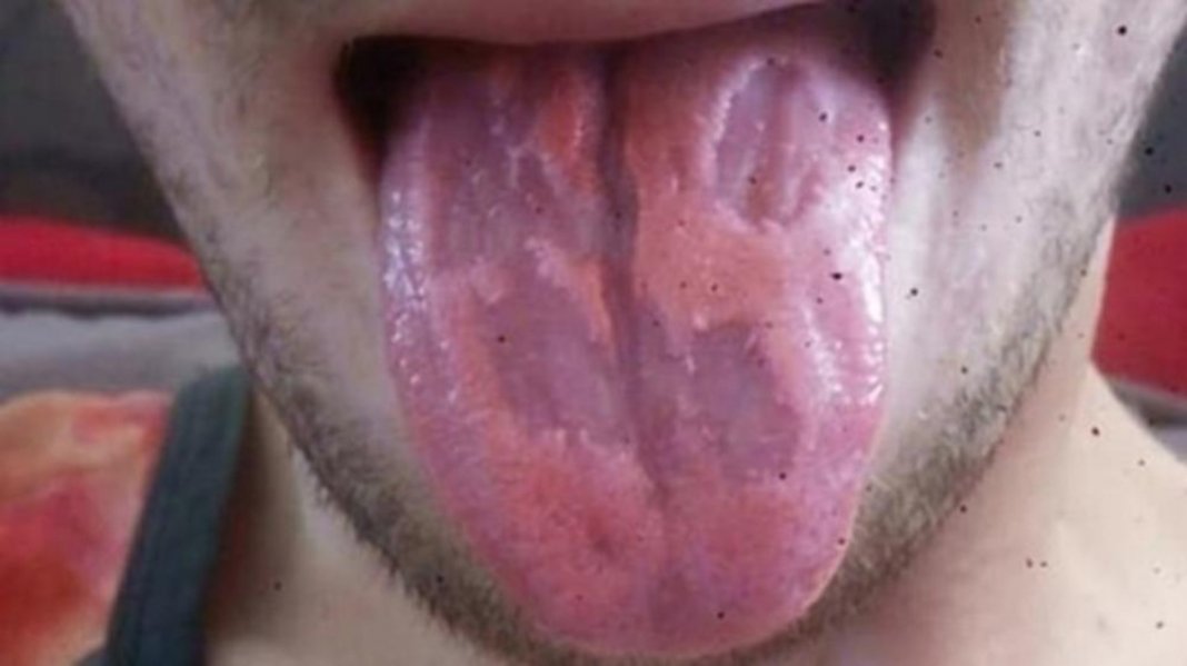 Professor tem dano na língua após beber energético