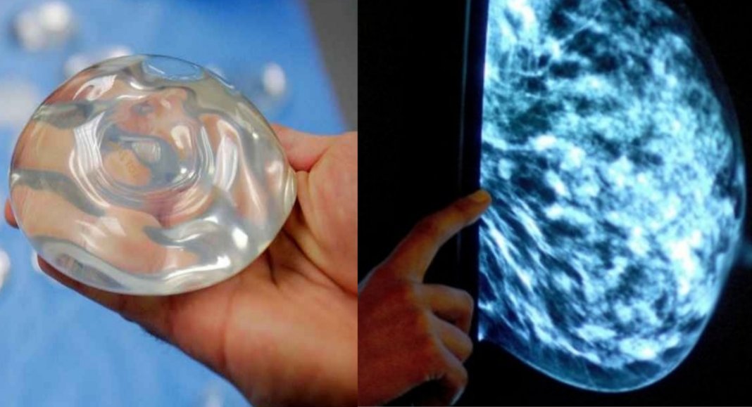 Forma rara de câncer é encontrado em 660 mulheres devido aos implantes de mama