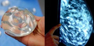 Forma rara de câncer é encontrado em 660 mulheres devido aos implantes de mama