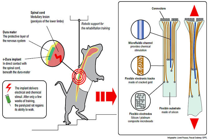 sabervivermais.com - Novo implante na medula permite recuperar a capacidade de andar