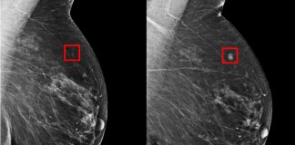 Modelo de inteligência artificial consegue prever o câncer de mama cinco anos antes