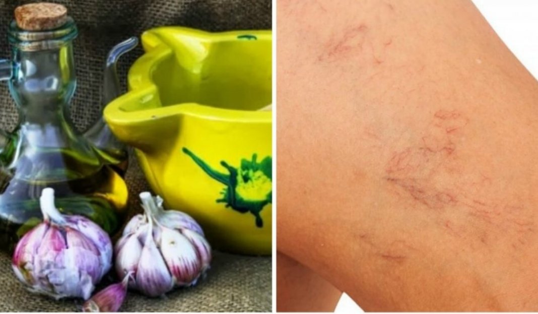 Alho e óleo de oliva, essa mistura combate inflamações e ajuda amenizar varizes