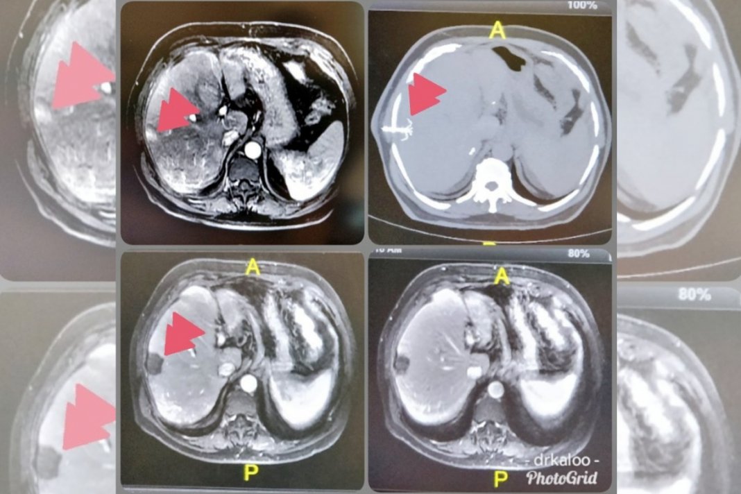 Novo tratamento contra câncer destrói tumor em 4 minutos