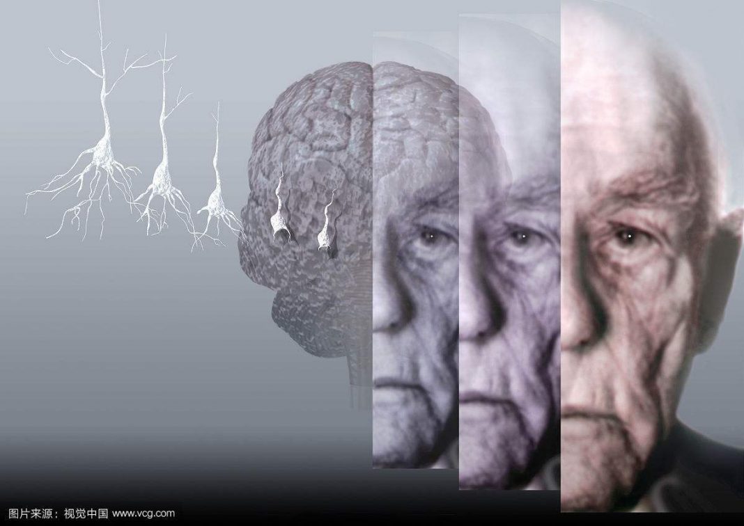 Novo achado aproxima cientistas italianos da cura do Alzheimer