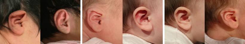 sabervivermais.com - Molde permite acabar com orelhas de abano em recém nascidos