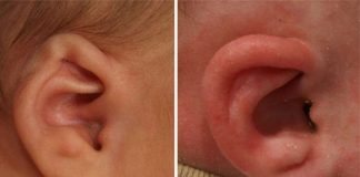 Molde permite acabar com orelhas de abano em recém nascidos