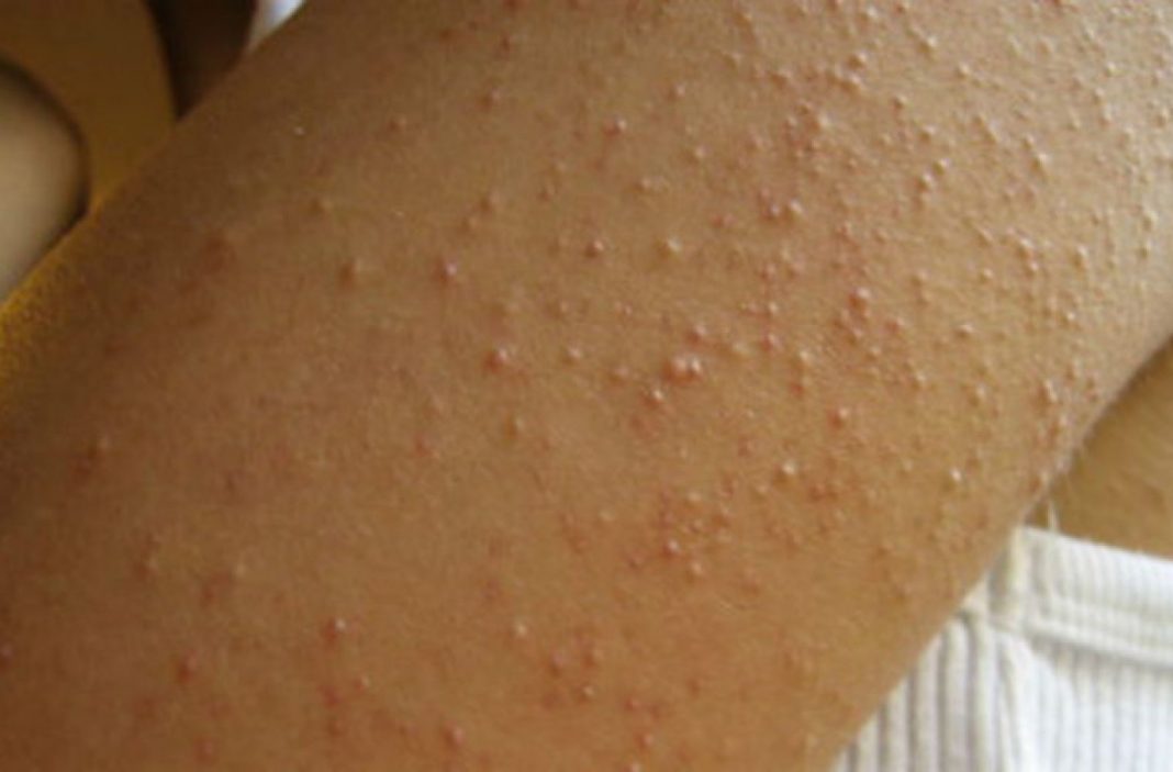 Alergia ao glutén é a maior causa das “bolinhas” no braço