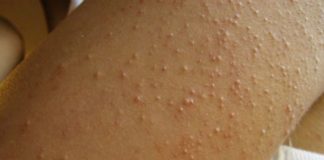 Alergia ao glutén é a maior causa das “bolinhas” no braço