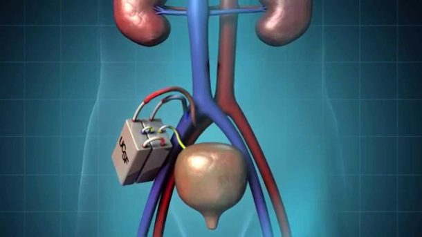 sabervivermais.com - Rim artificial elimina a necessidade de diálise renal