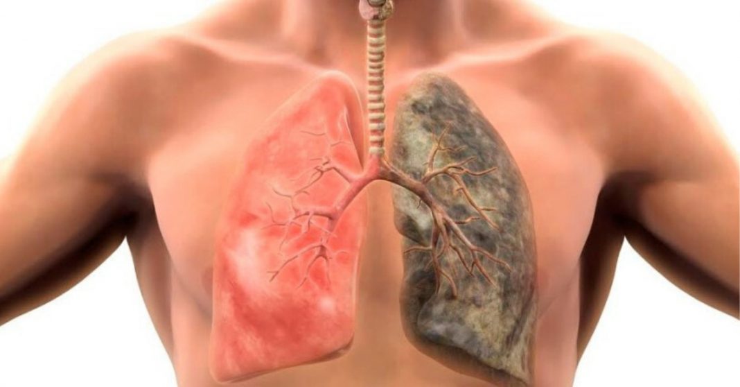 Os pulmões podem se regenerar se você parar de fumar! Saiba mais