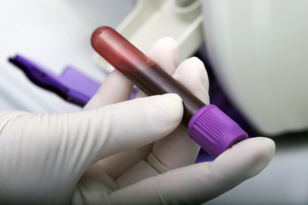 Exames de sangue podem substituir biópsias e ressonâncias magnéticas