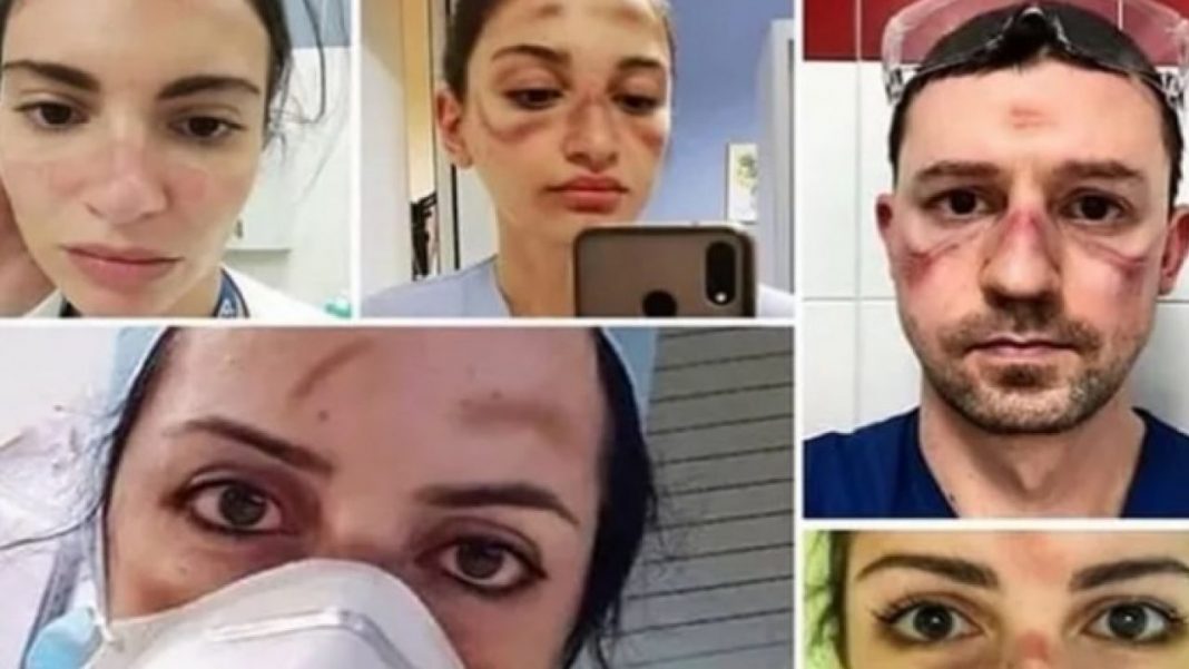 Médicos comovem o mundo com selfies mostrando as marcas da luta contra o covid-19