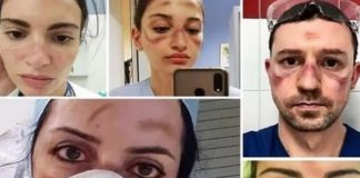 Médicos comovem o mundo com selfies mostrando as marcas da luta contra o covid-19