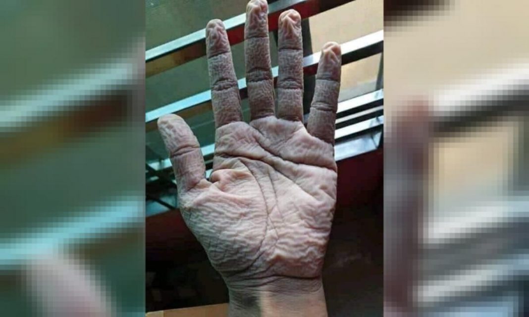 Foto de mãos enrugadas de um médico após usar luvas por 10 horas. “Gratidão aos heróis da linha de frente ”