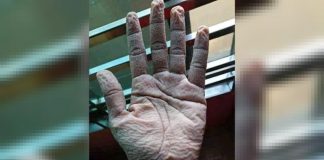 Foto de mãos enrugadas de um médico após usar luvas por 10 horas. “Gratidão aos heróis da linha de frente ”
