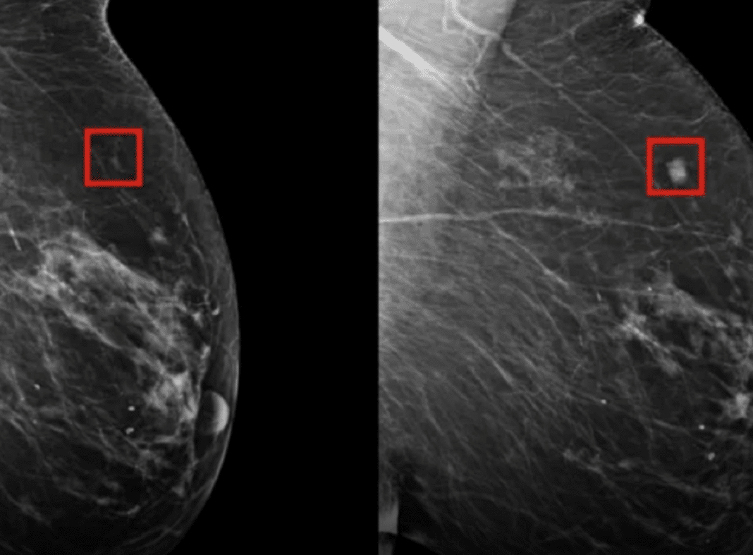 IA detecta câncer de mama 5 anos antes dele evoluir