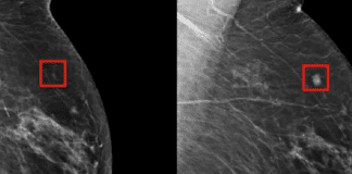 IA detecta câncer de mama 5 anos antes dele evoluir
