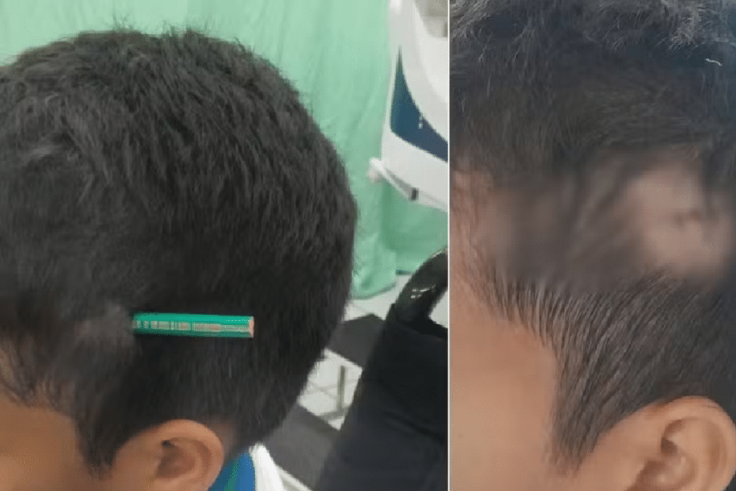 Estudante crava lápis na cabeça de colega após briga na escola