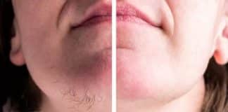 Saiba o que significa ter pelos crescendo no queixo (e quando se preocupar)