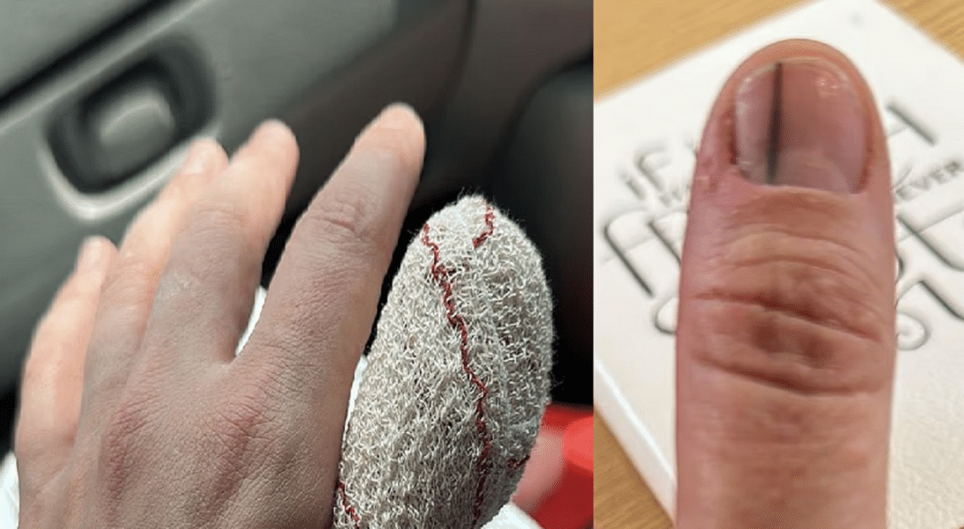 Mãe faz alerta urgente sobre unhas postiças após esconderem sinal sinistro de câncer