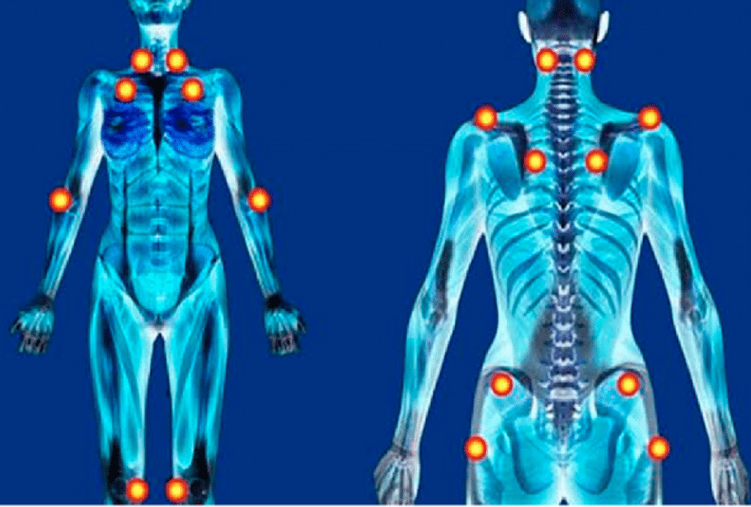 Fibromialgia: como vírus comuns podem estar desencadeando dores que ninguém vê