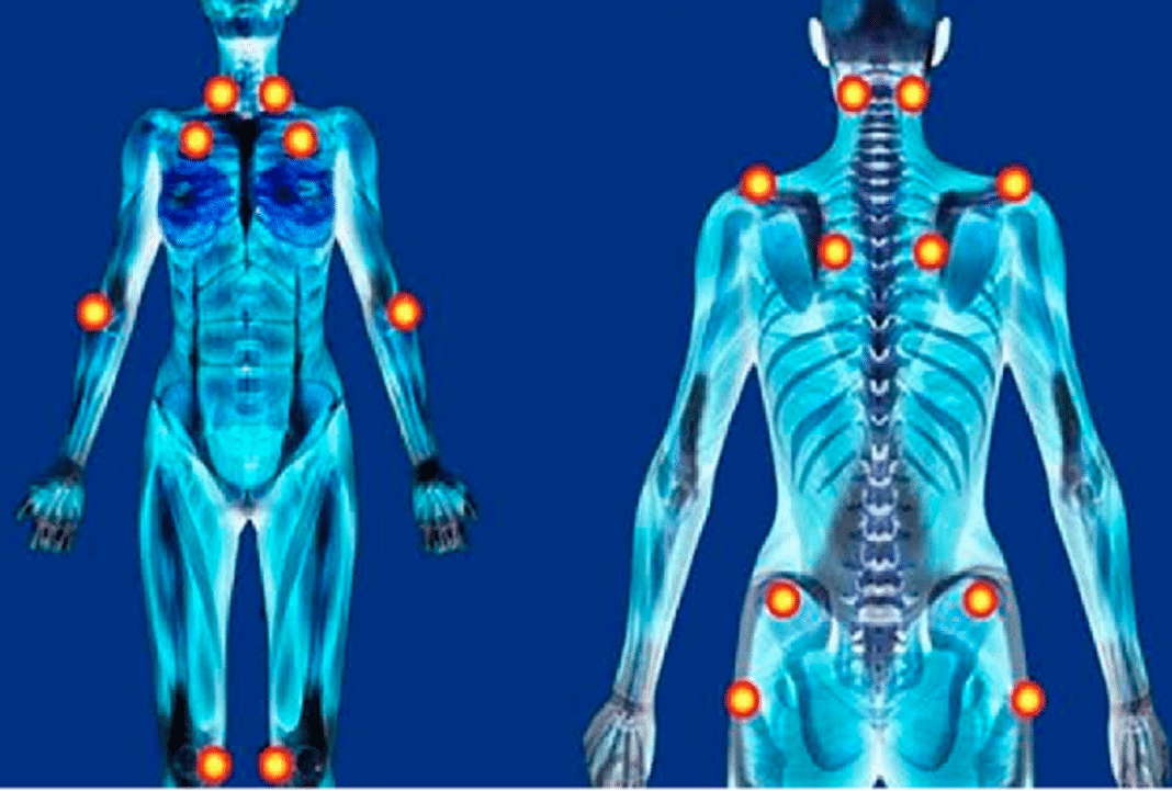 Fibromialgia: como vírus comuns podem estar desencadeando dores que ninguém vê