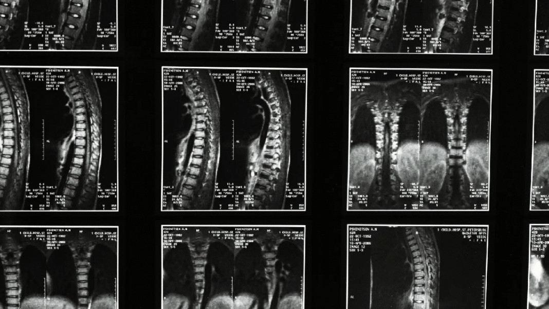 Israel irá realizar o primeiro transplante de medula espinhal do mundo e espera que pacientes voltem a andar