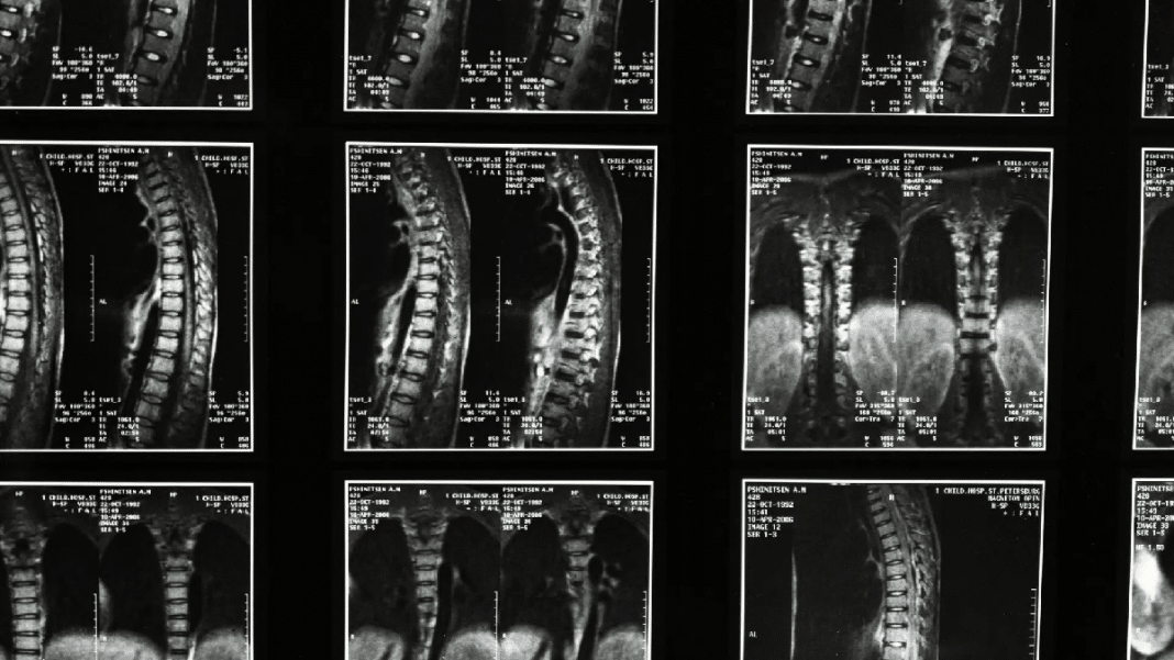Israel irá realizar o primeiro transplante de medula espinhal do mundo e espera que pacientes voltem a andar