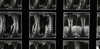 Israel irá realizar o primeiro transplante de medula espinhal do mundo e espera que pacientes voltem a andar
