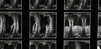 Israel irá realizar o primeiro transplante de medula espinhal do mundo e espera que pacientes voltem a andar