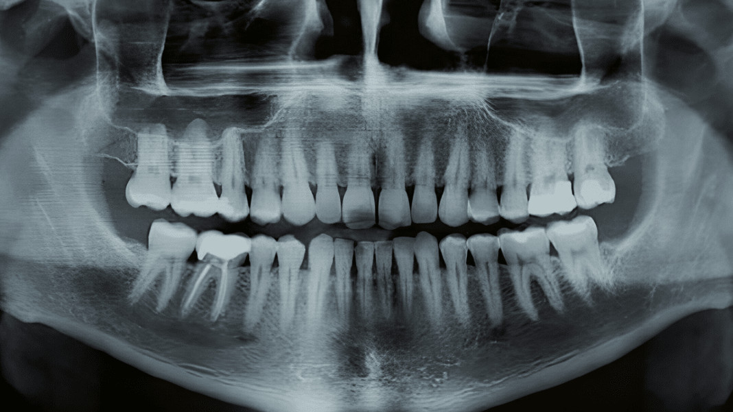 Chega de dentadura ou implantes? Japão testa remédio que faz nascer dentes de novo!