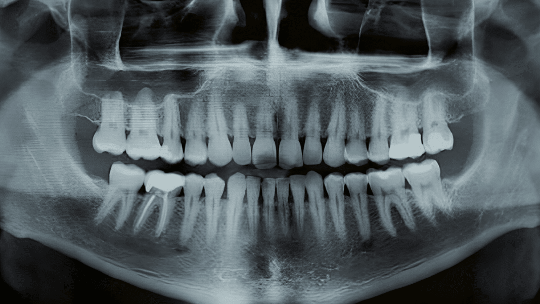 Chega de dentadura ou implantes? Japão testa remédio que faz nascer dentes de novo!