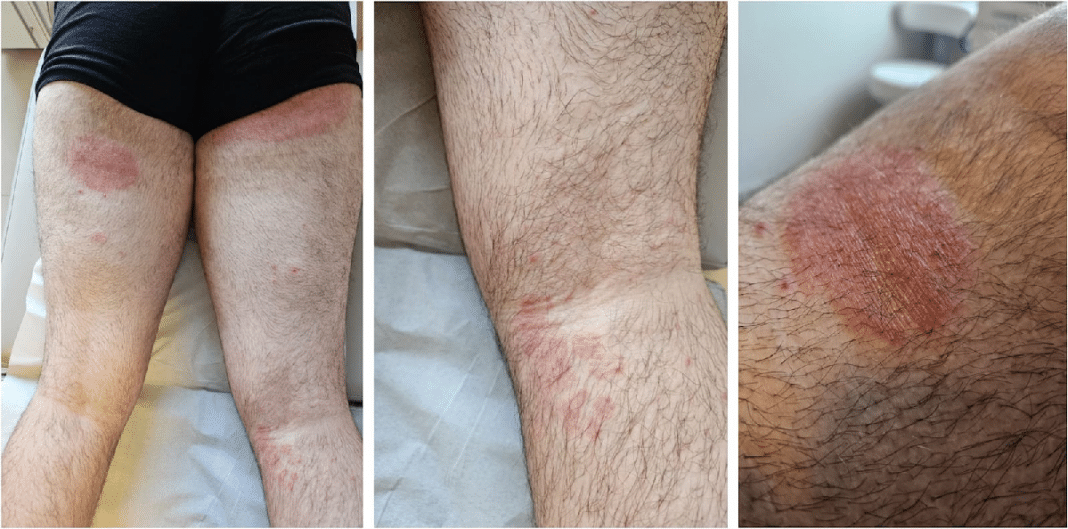 Autoridades emitem alerta após surgimento de superfungo resistente que provoca infecções na virilha e nas nádegas