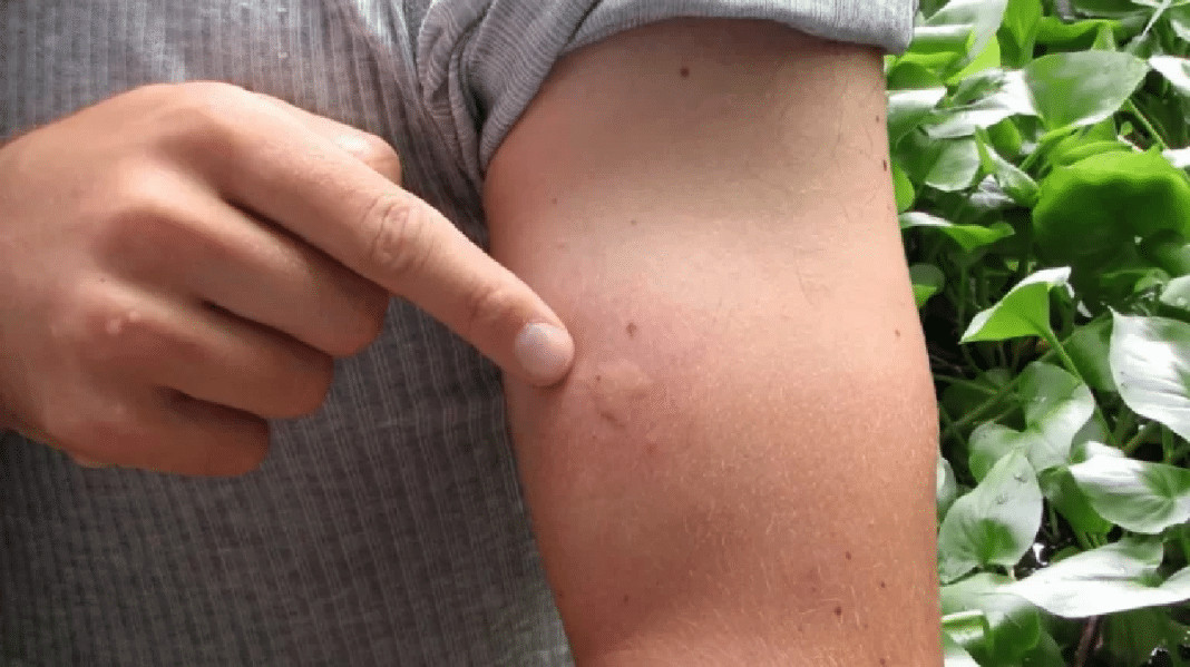 Não é azar: se você sempre é o escolhido pelos mosquitos, a ciência explica — e o motivo pode te surpreender