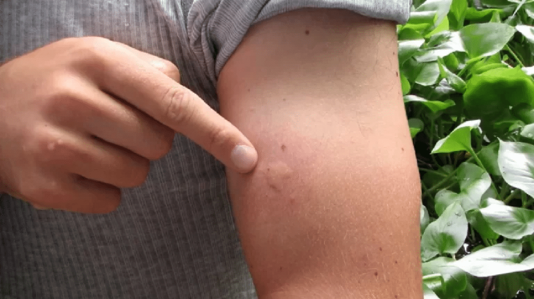 Se você sempre é o escolhido pelos mosquitos, a ciência explica — e o motivo vai te deixar chocado