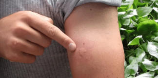 Não é azar: se você sempre é o escolhido pelos mosquitos, a ciência explica — e o motivo pode te surpreender