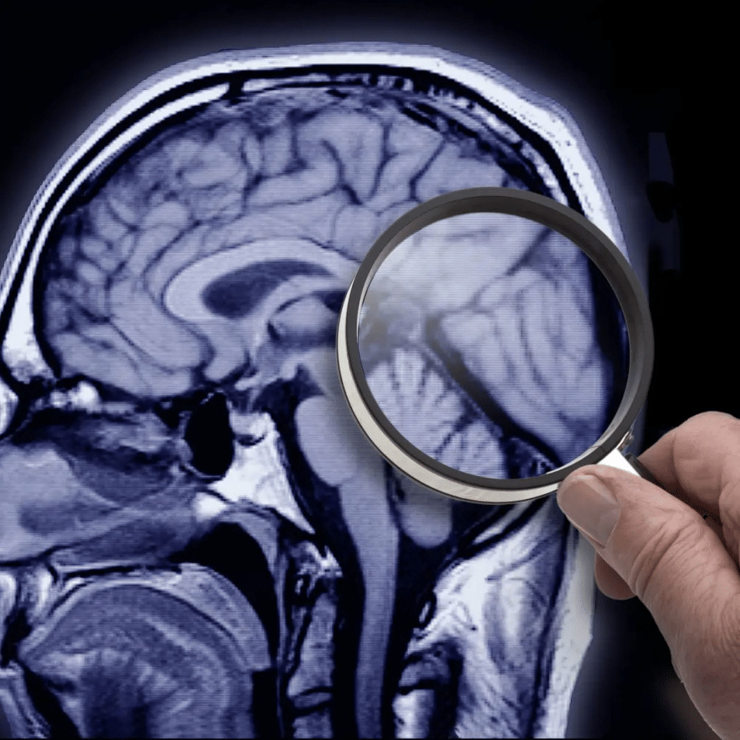 “Era das curas”? Pesquisadores conseguem remover placas do Alzheimer e mostram melhora em estudos iniciais